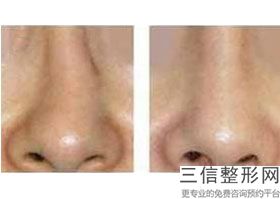 郑州哪个整形医院做鼻子好！郑州美莱医疗美容医院锁定前十
