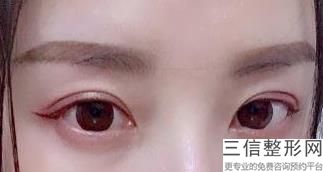 郑州双眼皮整形医生排名前十盘点！实力非凡