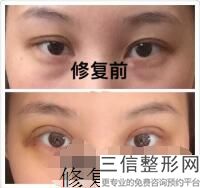 郑州双眼皮整形医院排名！首次上榜