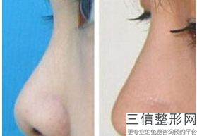 株洲比较好的肋骨隆鼻整形机构排名！湖南星薇美医疗美容有限公司实力入围