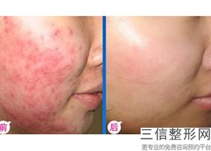北京三甲医院拉皮整形排名表前五！北京空军总医院整形外科排名靠前