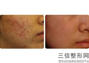 北京三甲医院拉皮整形排名表前五！北京空军总医院整形外科排名靠前