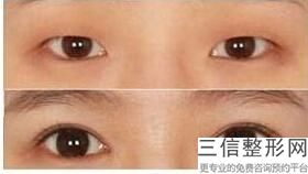 长春整形医院做双眼皮哪家好！ 长春爱美整形美容门诊部遥遥领先