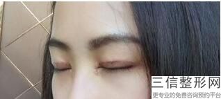 长沙眼部和眉部整形的排名!口碑良好