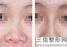 福建鼻部民营整形医院排名！厦门银河整形美容不容错过