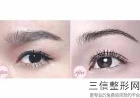 广州眼整形医生排名前十！李宗磊医生实力超强