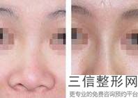 贵阳哪家整形医院做隆鼻比较好！贵阳美莱医疗美容医院首次上榜