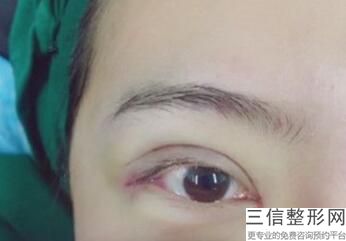 国内拉双眼皮整形医院排名前十曝光！上海华美整形医院实力上榜