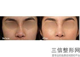 哈尔滨隆鼻整形医生排行榜前十！吴谦医生锁定前十