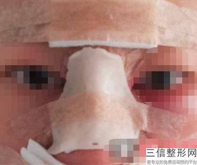 哈尔滨隆鼻整形医院排行榜前十！哈尔滨斯美诺整形医院排名靠前