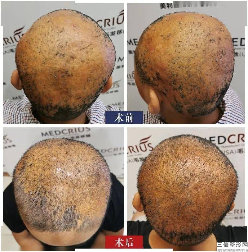 合肥植发医院排名！遥遥领先