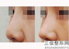 河南鼻部整形较新正规医院排名！郑州望京医疗美容诊所实力非凡