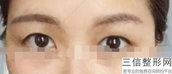 济南做双眼皮好的正规医院排名！首次上榜