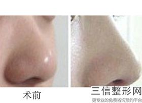 昆明假体隆鼻医院排名！实力入围