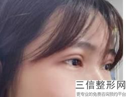 泉州双眼皮整形医院排名榜前五推荐!实力上榜