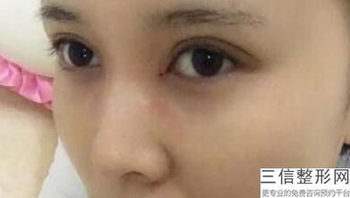 厦门美莱双眼皮医生排名前六名单！邵宁不容错过