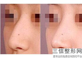 上海九院整形科隆鼻专家有哪些！魏皎医生排名靠前