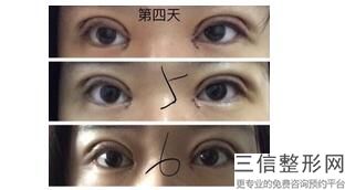 深圳做双眼皮良好的医院排名！深圳曹孟君医疗美容门诊部首次上榜