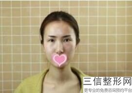深圳做双眼皮良好的医院排名！深圳曹孟君医疗美容门诊部首次上榜