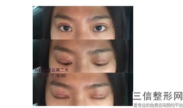 深圳做双眼皮良好的医院排名！深圳曹孟君医疗美容门诊部首次上榜