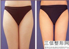 沈阳冷冻溶脂瘦大腿医院排名！位列前十