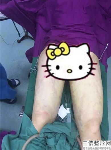 沈阳冷冻溶脂瘦大腿医院排名！位列前十