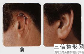 沈阳自体脂肪丰耳垂医院排名！不容错过