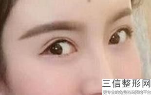 天津双眼皮手术哪个医院比较好!天津伊颂整形排名靠前