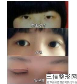 西安割双眼皮医院排名前十风靡全城！西安美之为美医疗美容门诊部排名靠前