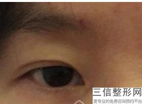 西安割双眼皮整形医院排行前十！西安画美医疗美容实力入围
