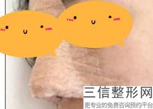 西安做鼻综合整形医院排名前十！西安叶子整形医院实力超强