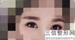 郑州割双眼皮医院排名榜！郑州方胜医疗美容诊所实力上榜