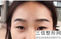 北京眼部整形医生排名前十！张冰洁实力入围