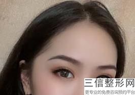 北京眼部整形医生排名前十！张冰洁实力入围