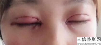 长春割双眼皮医院排名前十！长春珍妮整形美容医院首次上榜