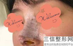长沙整鼻子（隆鼻）良好的医院排名前六！ 长沙丽莎医学美容门诊部口碑良好