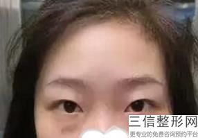 成都割双眼皮十强医院！成都臻爱微美医疗美容医院实力入围