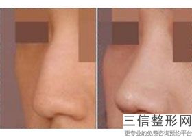 成都隆鼻出名医院有哪些!成都水晶唯罗纳医疗美容门诊部实力超强