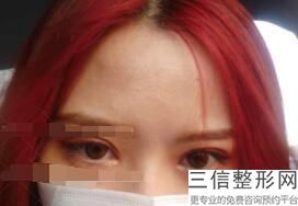 成都双眼皮手术哪家好！成都栖羽医疗美容门诊部实力入围