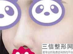 大连隆鼻整形医院哪个比较好！大连悦己时光医疗美容医院不容错过