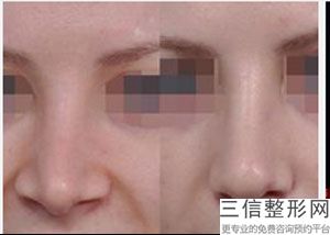 大连隆鼻整形医院哪个比较好！大连悦己时光医疗美容医院不容错过