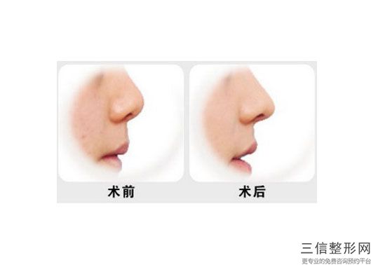 东莞鼻整形医院五大排名！东莞西妃美容医院位列前十