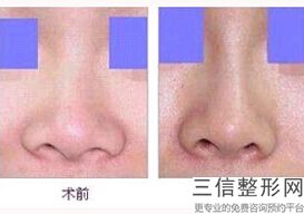 东莞鼻整形医院五大排名！东莞西妃美容医院位列前十