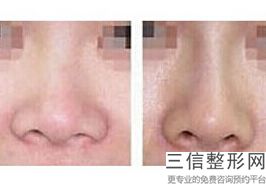 东莞隆鼻整形医院排名前六！ 东莞华美医疗美容医院口碑良好