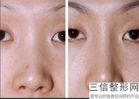 东莞隆鼻整形医院排名前六！ 东莞华美医疗美容医院口碑良好