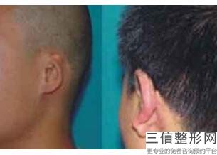 东莞十大自体耳软骨隆鼻整形医院排名榜！东莞天姬医疗美容机构实力上榜