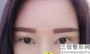东莞双眼皮医院排行榜前五！东莞美立方整形医院不容错过