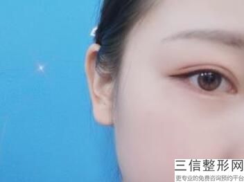东莞双眼皮医院排行榜前五！东莞美立方整形医院不容错过