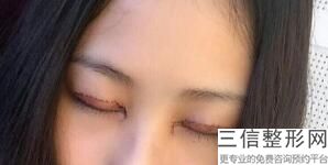 广东揭阳割双眼皮医院排名前六！揭阳普宁安琪医院排名靠前