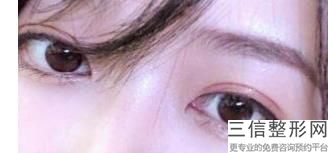广州双眼皮专家排名前八！ 陈伯华医生位列前十